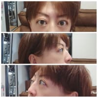 バセドウ病眼症減圧術後１ヶ月