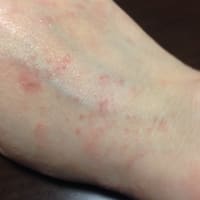 手の毒だし 第2弾