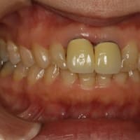 知ってますか？差し歯が古くなると歯茎が下がって歯茎が黒く見えてきます。