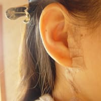 耳下腺腫瘍とは 耳下腺腫瘍診断記録