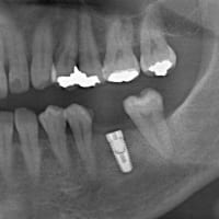 抜歯後の治療法としてインプラントは有効です