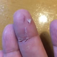 噛まれた右手中指