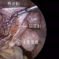 子宮筋腫核出術への私のこだわり４ - 子宮の縫合修復 -