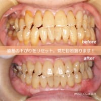 歯茎の下がりをリセット。専門治療で歯の美しさと健康を回復します。