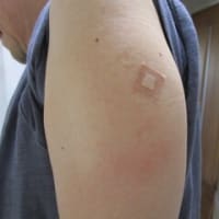 帯状疱疹ワクチン2回目接種の副反応につきまして