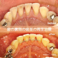 前歯の裏側の歯茎の再生治療