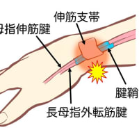 手首の痛みに対する「安静」以外の治療方法