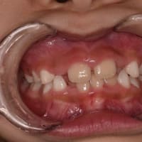 永久歯反対（交叉）咬合の早期アプローチ