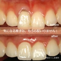 歯茎の黒ずみ治療：再生療法とセラミックによる美しい笑顔へのアプローチ