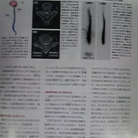 「ニュートン」３月号に脳脊髄液減少症治療法