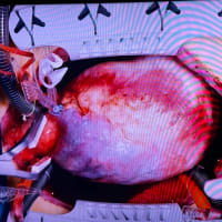 ブラックペアン２についての感想（続き）