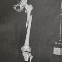 左大腿骨骨幹部骨折の概要