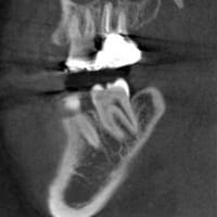 最新技術で安心診療！歯科用CTの有用性