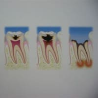 歯科助手　の為の　歯の解剖