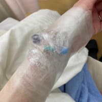 扁桃腺手術して6日目（入院8日目）