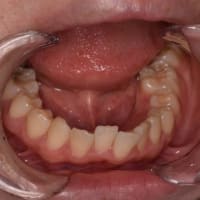 抜歯矯正の抜歯部位診断の根拠