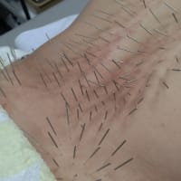 医者不審と鍼治療