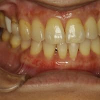 歯茎の再生治療例　下の前歯の歯茎が下がってしまったケース