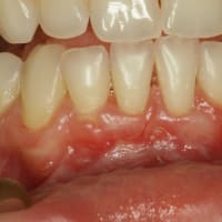 歯茎が下がったところには歯石がつきやすくなる場合があります。
