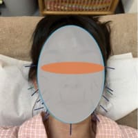 美容鍼灸：momokoの美容鍼　（^o^）