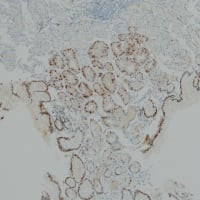 Cyclin D1, oxyntic gland adenoma, gastric adenocarcinoma of fundic gland type