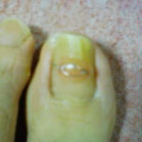 矯正治療中