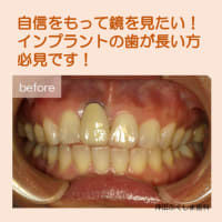 インプラントの歯茎再生で気にしていた歯茎の黒ずみや、セラミックの歯が長く見える悩みが解決したケースをご紹介します。