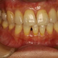 歯茎の再生治療例　下の前歯の歯茎が下がってしまったケース