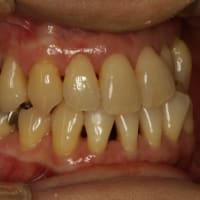 矯正治療の後に下の前歯の歯茎が下がってしまうことがよくあります。