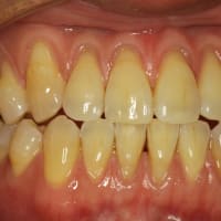 歯茎の再生治療例　〜若いのに全体的に歯茎が下がってしまった方の例〜
