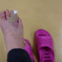 足の指、骨折