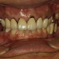 前歯の差し歯は、古くなると汚く見えます。その原因はご存知ですか？