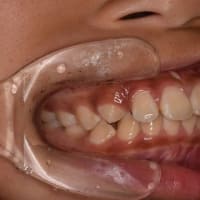 口腔機能に影響ある噛み合わせ
