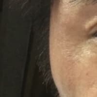 髪染めでジアミンアレルギー発症 治療の記録 southride サウスライド 髪染めでジアミンアレルギー発症 治療の記録 southride サウスライド