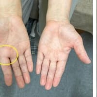 中手指節関節が腫れて痛い：七星鍼法