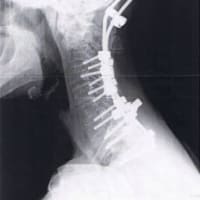 ５１　頚椎後方除圧固定術再手術終わりました