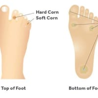 All you need to know about foot corns