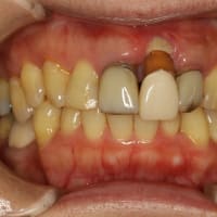 ３０歳以上で差し歯治療を行っている方には朗報です。差し歯の歯茎が下がってしまった時の治療法