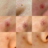 【毛穴比較】アイスピック毛穴を安価セルフで改善