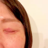 夕方、目の周りがひどくなってた