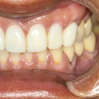 歯ぐきの再生治療はもうご存知でしょうか？　歯茎が下がったときの治療法です．