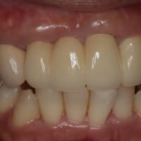 若いころに入れた前歯のセラミックが古くなって歯茎が下がってしまって、息が漏れたり、歯茎が黒くなったりしていませんか？