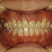 差し歯の長さは満足してますか？ 長い差し歯の治療法のご紹介です。