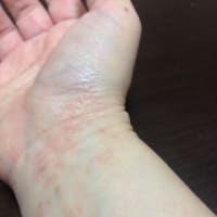 手の毒だし 第2弾
