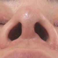 鼻中隔延長、小鼻縮小9ヶ月半