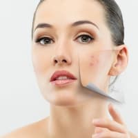 Acne Scar Treatment for Asian Skin