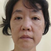 【症例紹介　白木様　片側顔面痙攣12年罹患　女性】
