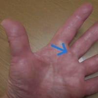 血管腫ができた