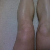 2009-01-11　膝の腫れ
