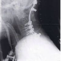 ５１　頚椎後方除圧固定術再手術終わりました